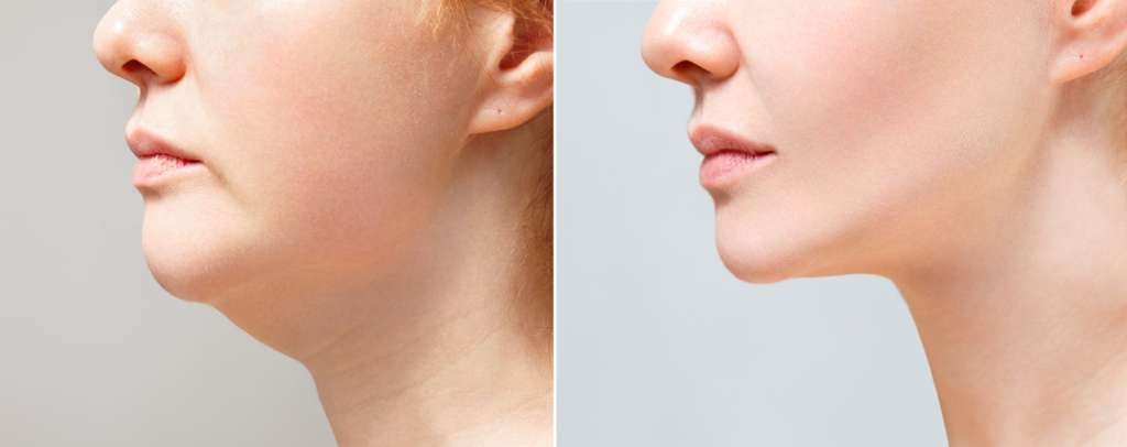 Chin Fat Removal Miami